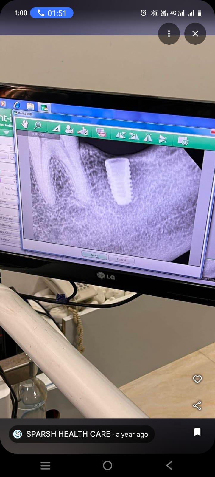 X-Ray Showing Dental Implant